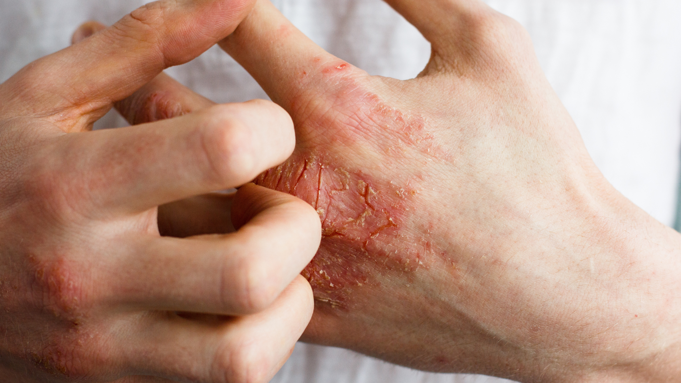 Eczema and Aging: How to Manage Symptoms as Your Skin Changes