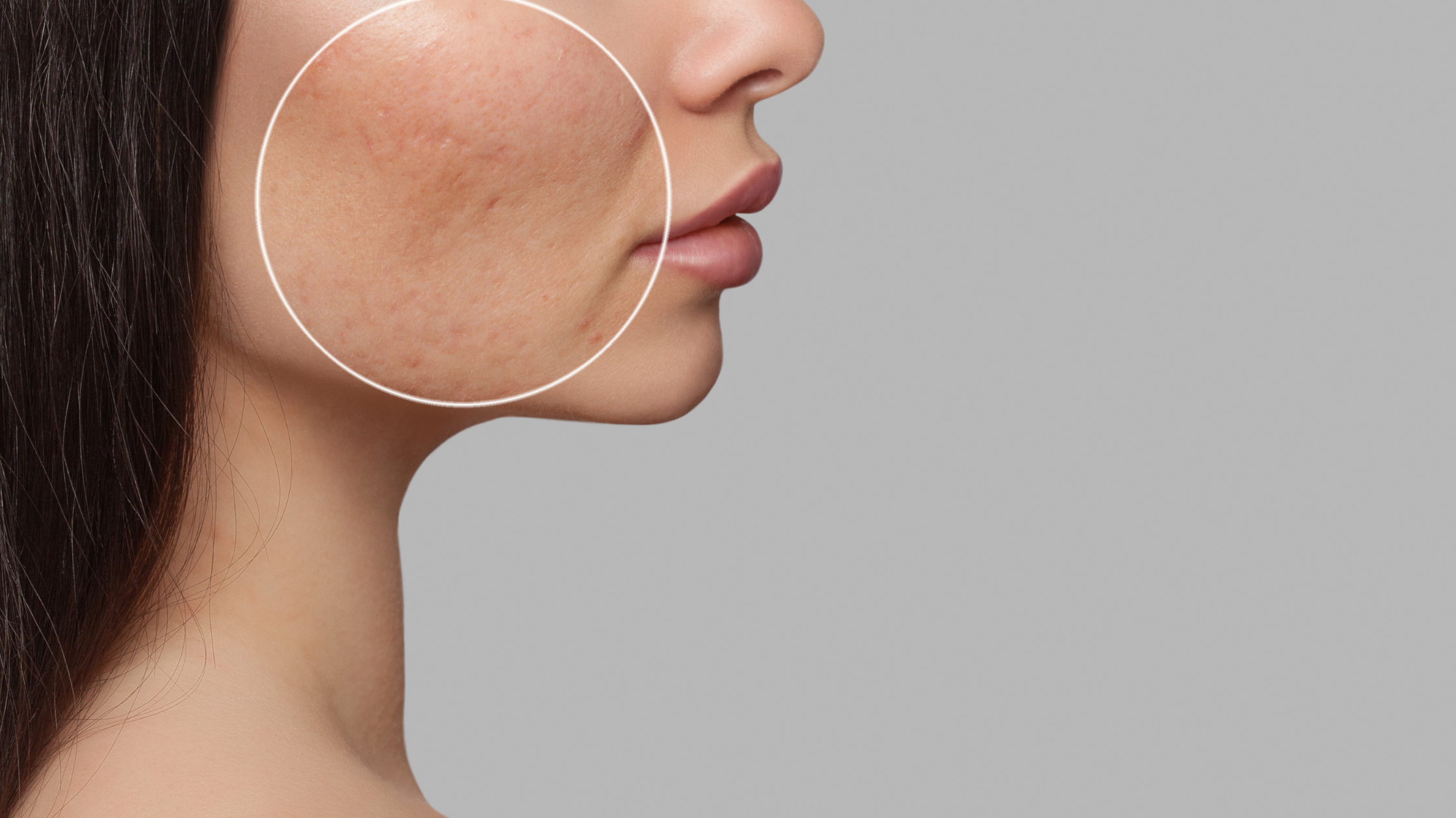 Tixel for Acne Scars: A Safe and Effective Solution for All Skin Types