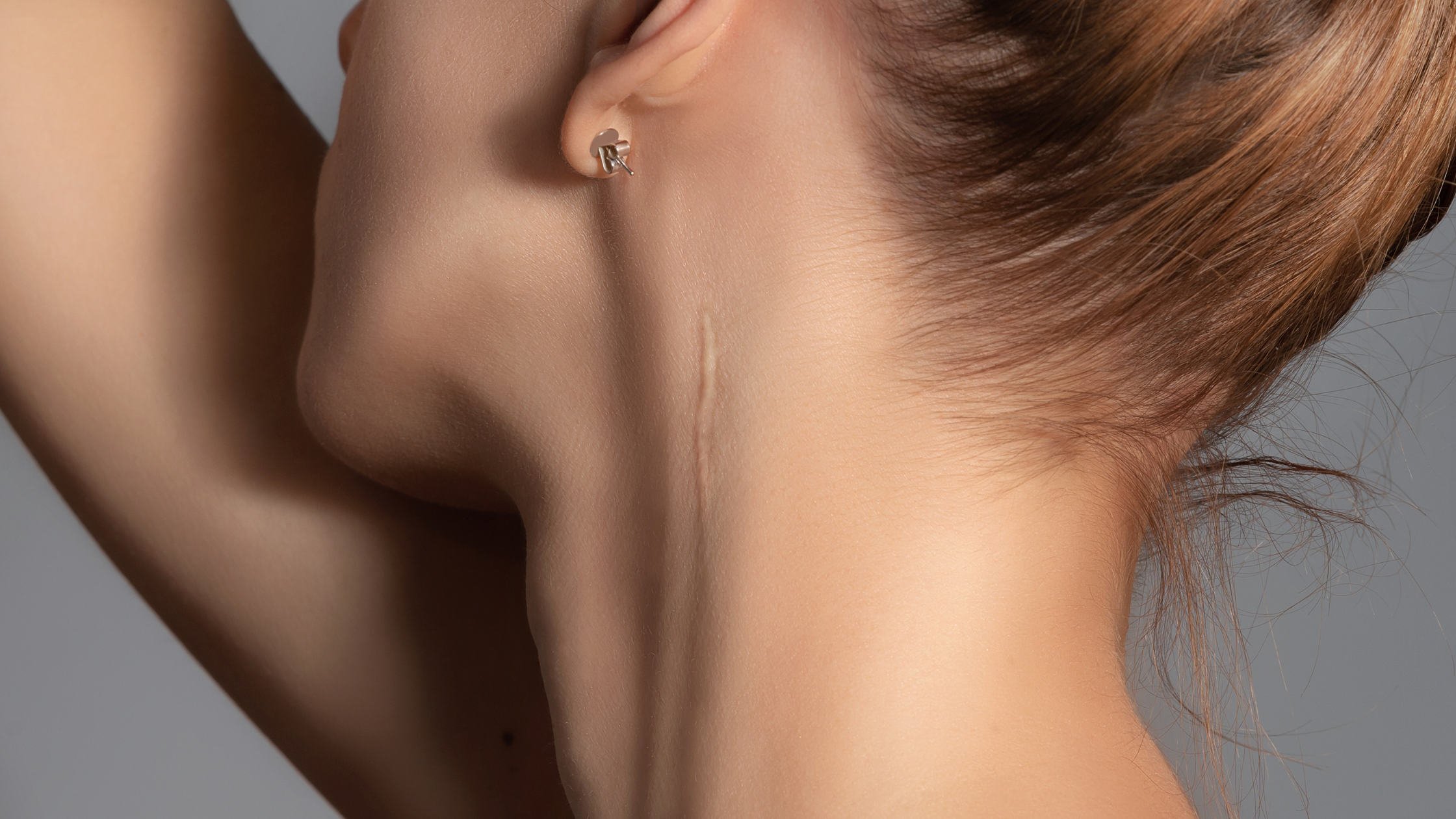 What Is Scar Revision? Everything You Need to Know About Minimizing Scars