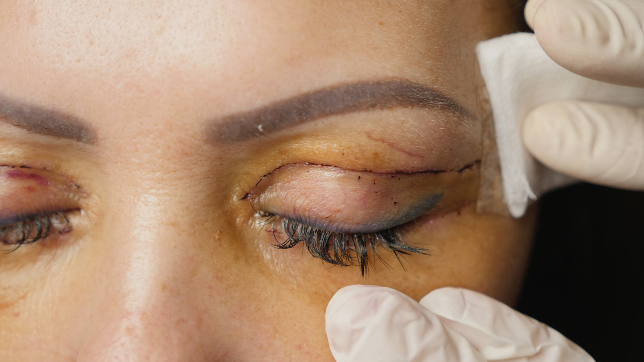 Blepharoplasty Scars: What to Expect and How to Minimize Them