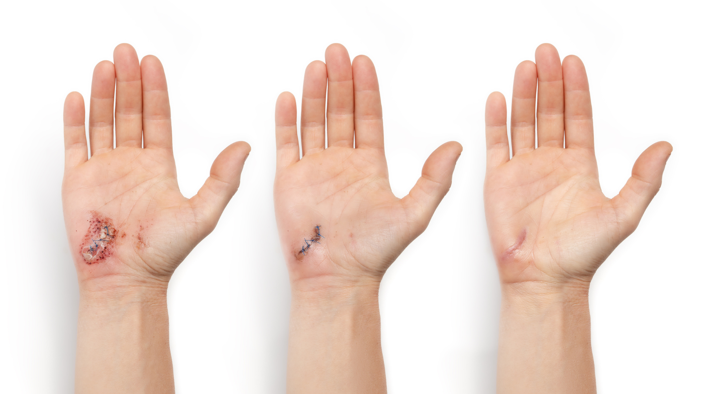 Why Isn’t My Skin Healing Faster? Understanding the 4 Stages of Wound Healing (and What You Can Do to Help)