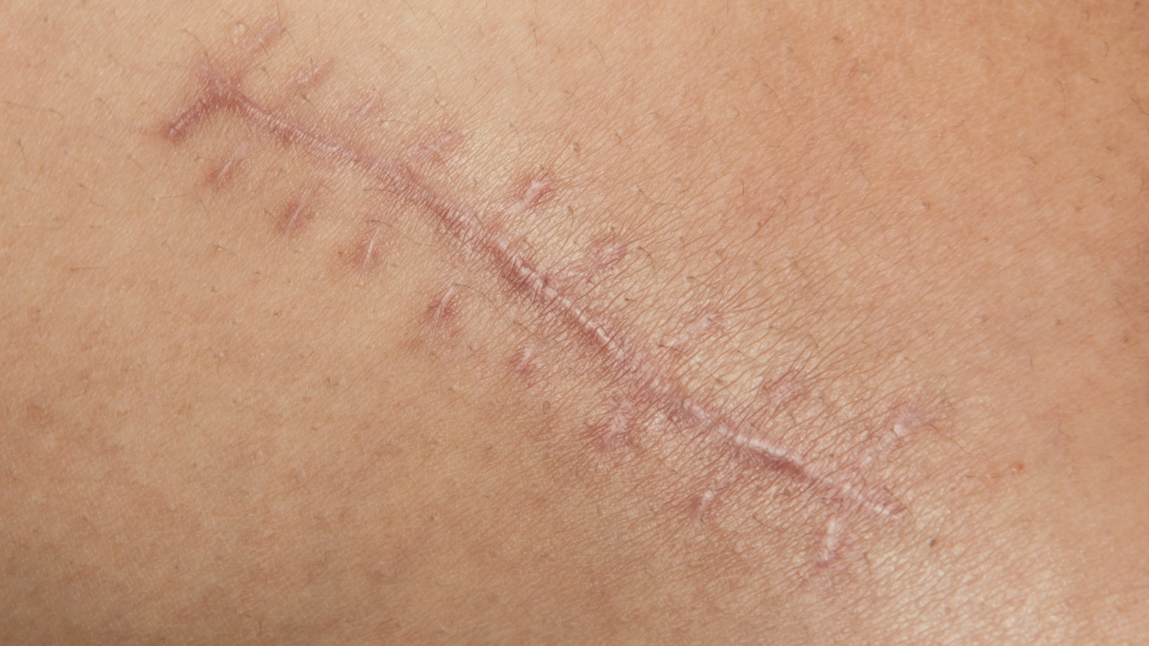 The Role of Silicone Scar Sheets and Gels in Scar Management: Which Is Better?