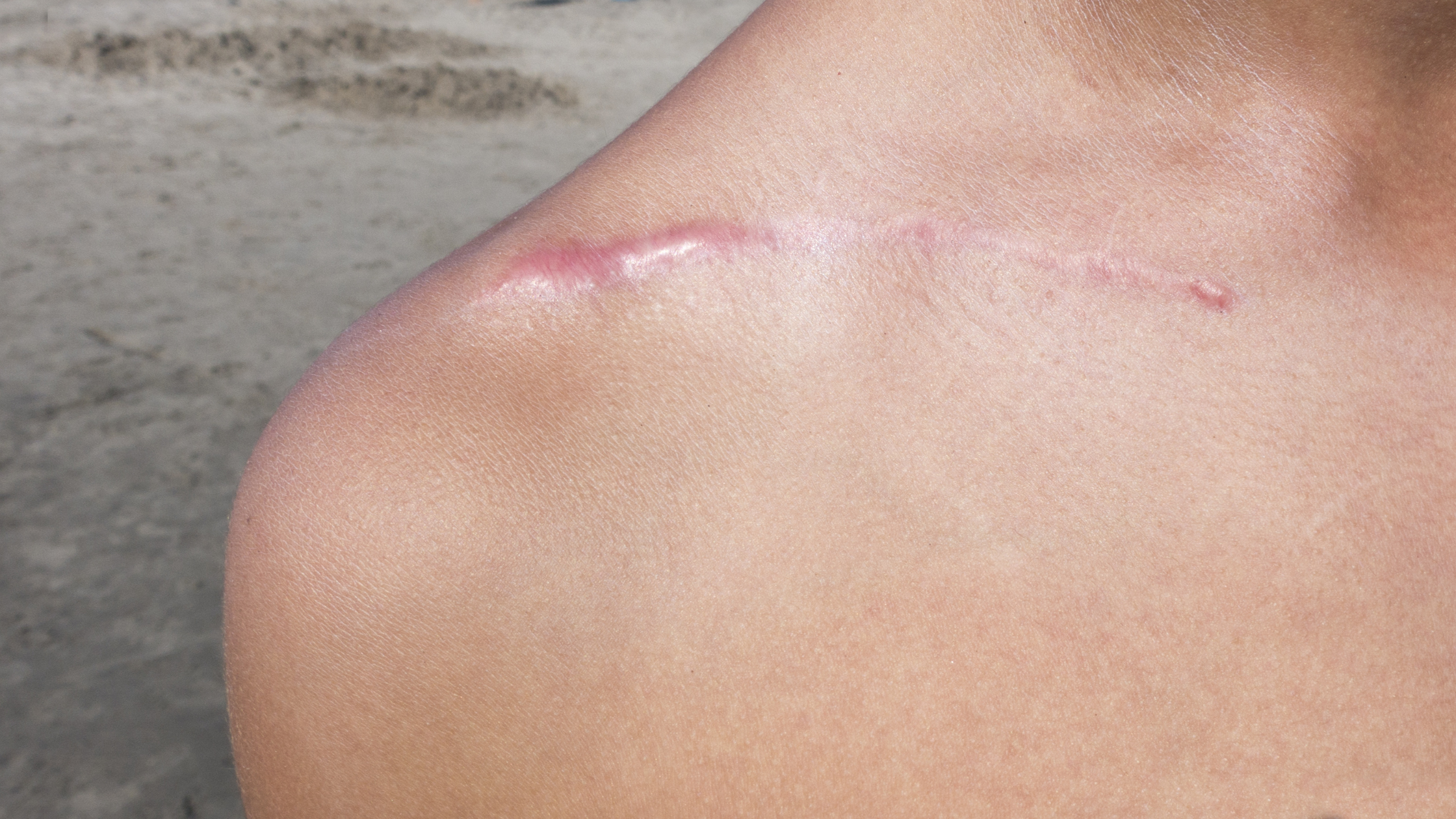 Understanding and Treating Scar Sensitivity: Itching, Pain & Nerve Issues