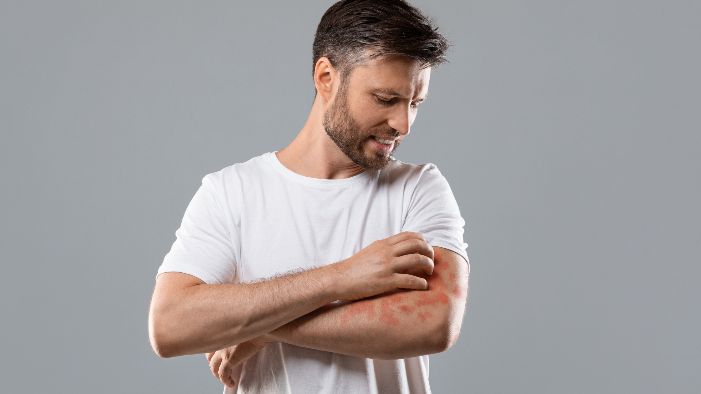 The Science Behind Eczema: What’s Happening Beneath Your Skin?