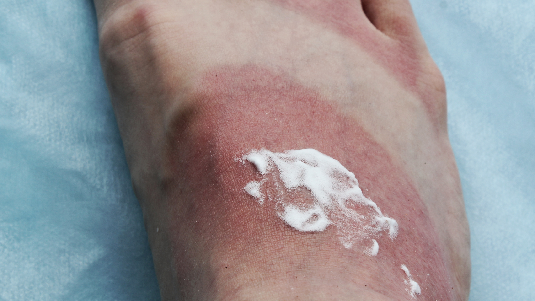 Managing Radiation Dermatitis: The Role of Skin Recovery Cream