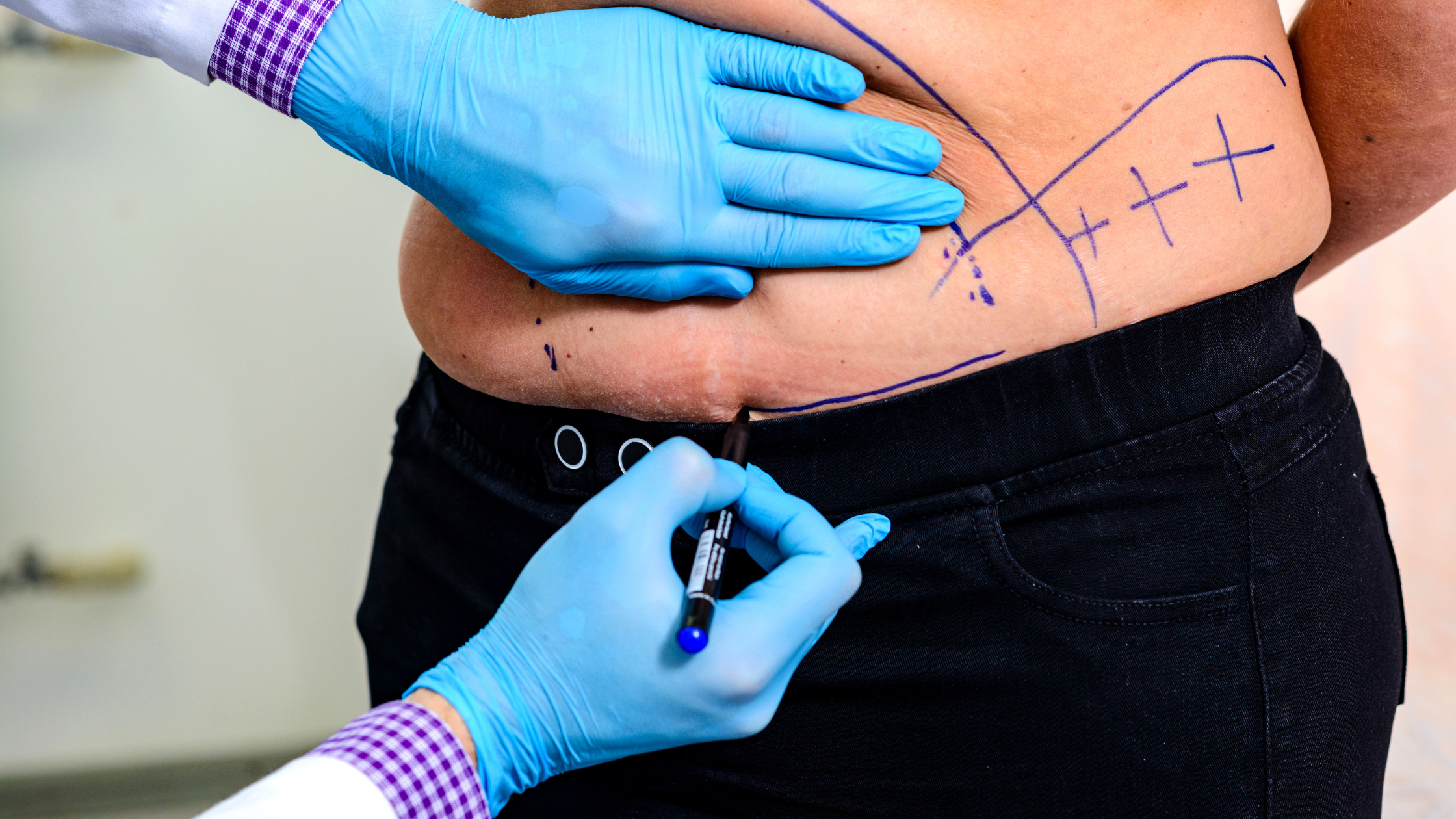 Minimize Tummy Tuck Scars: Your Guide to Healing & Scar Prevention