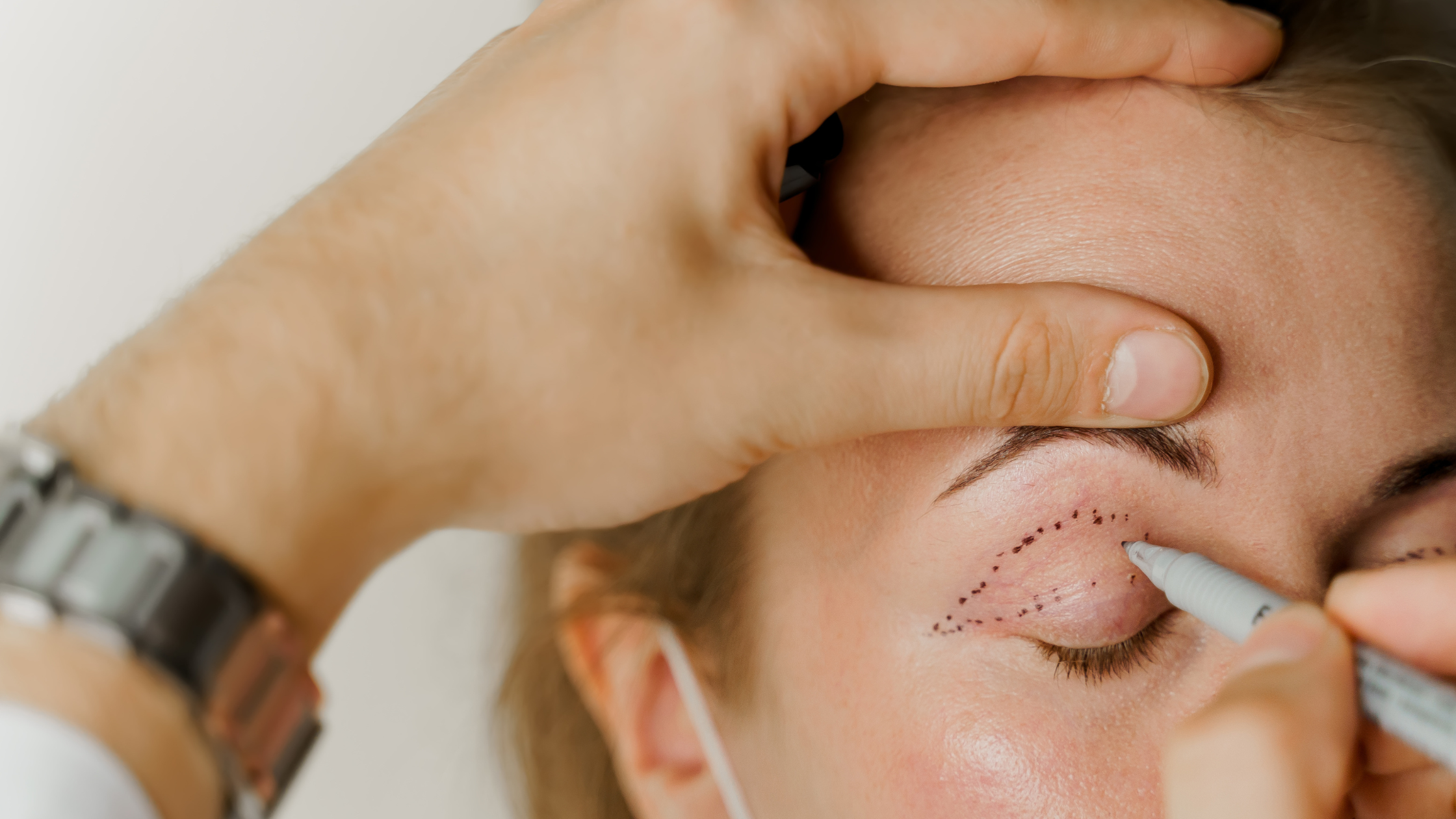 Common Blepharoplasty Mistakes & How to Avoid Them