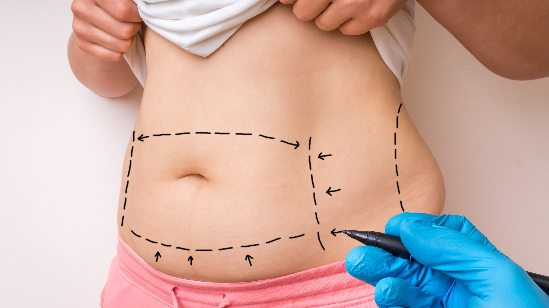 Understanding the Different Types of Tummy Tucks: Which One is Right for You?