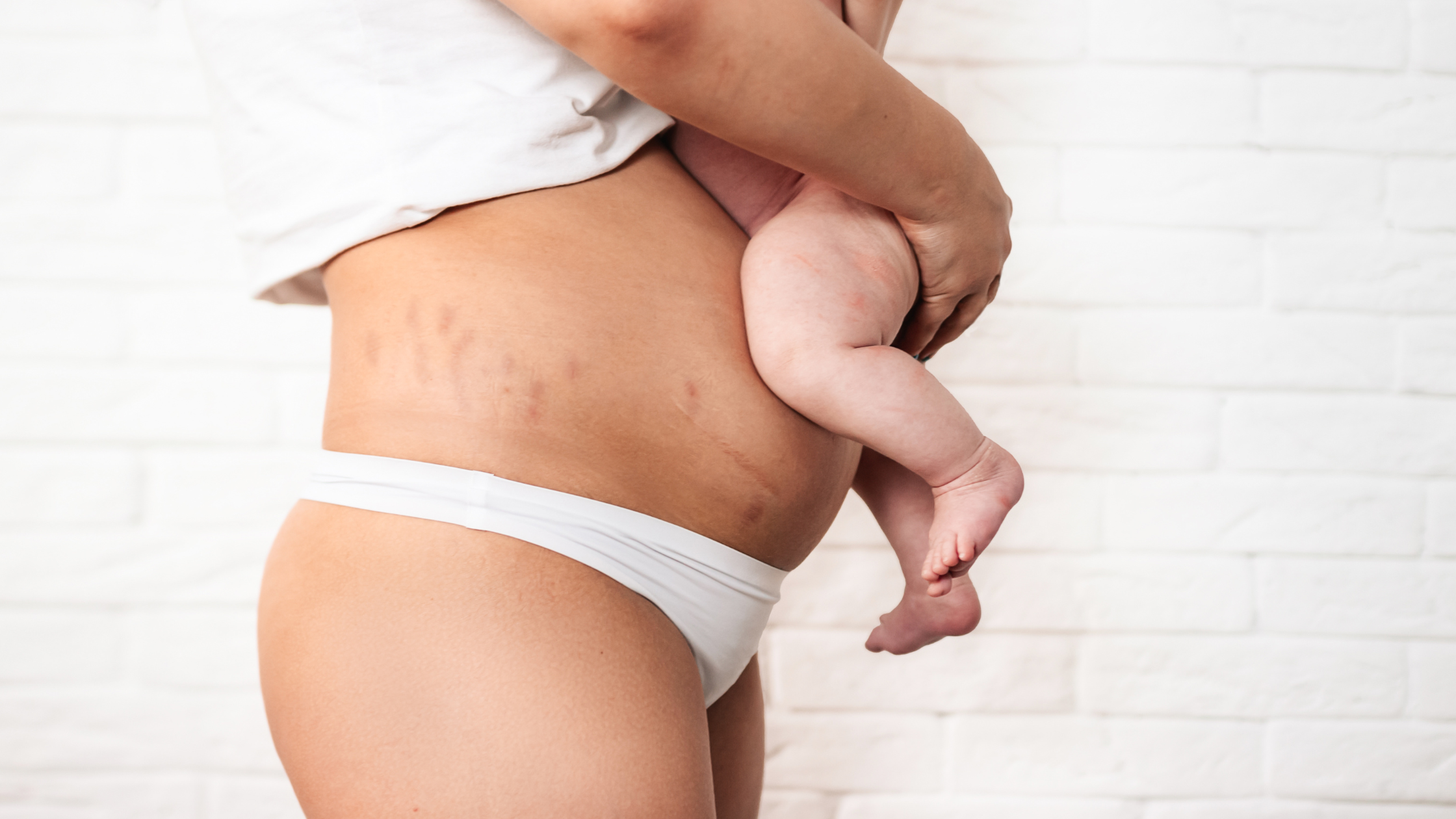 What’s Included in a Mommy Makeover? Everything You Need to Know Before Surgery