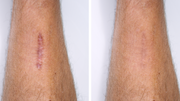 Surgical Scar Healing Stages: How to Fade Scars from Start to Finish ...