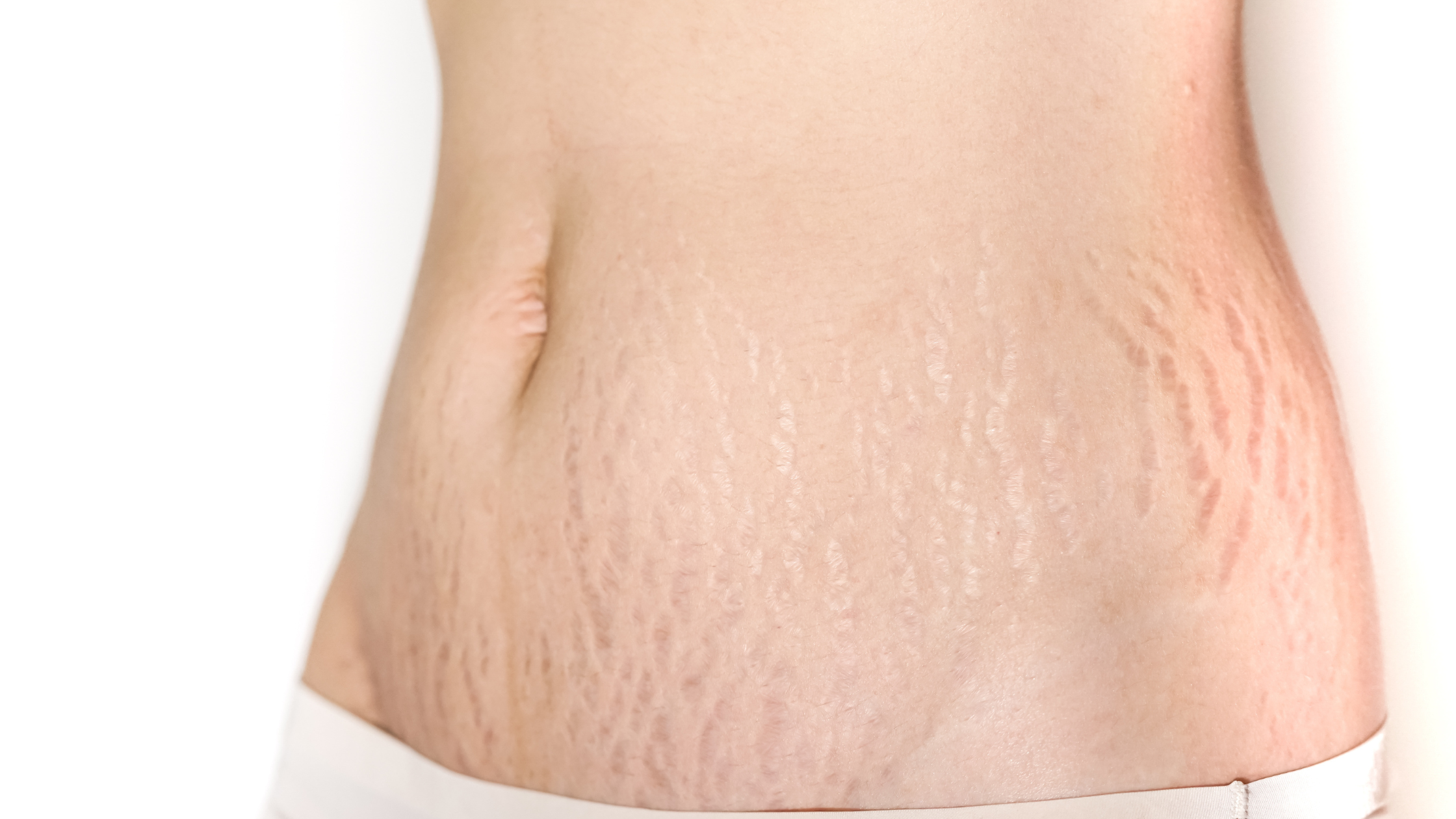 Laser vs. Microneedling for Stretch Marks: What Works Best—and How to Boost Results