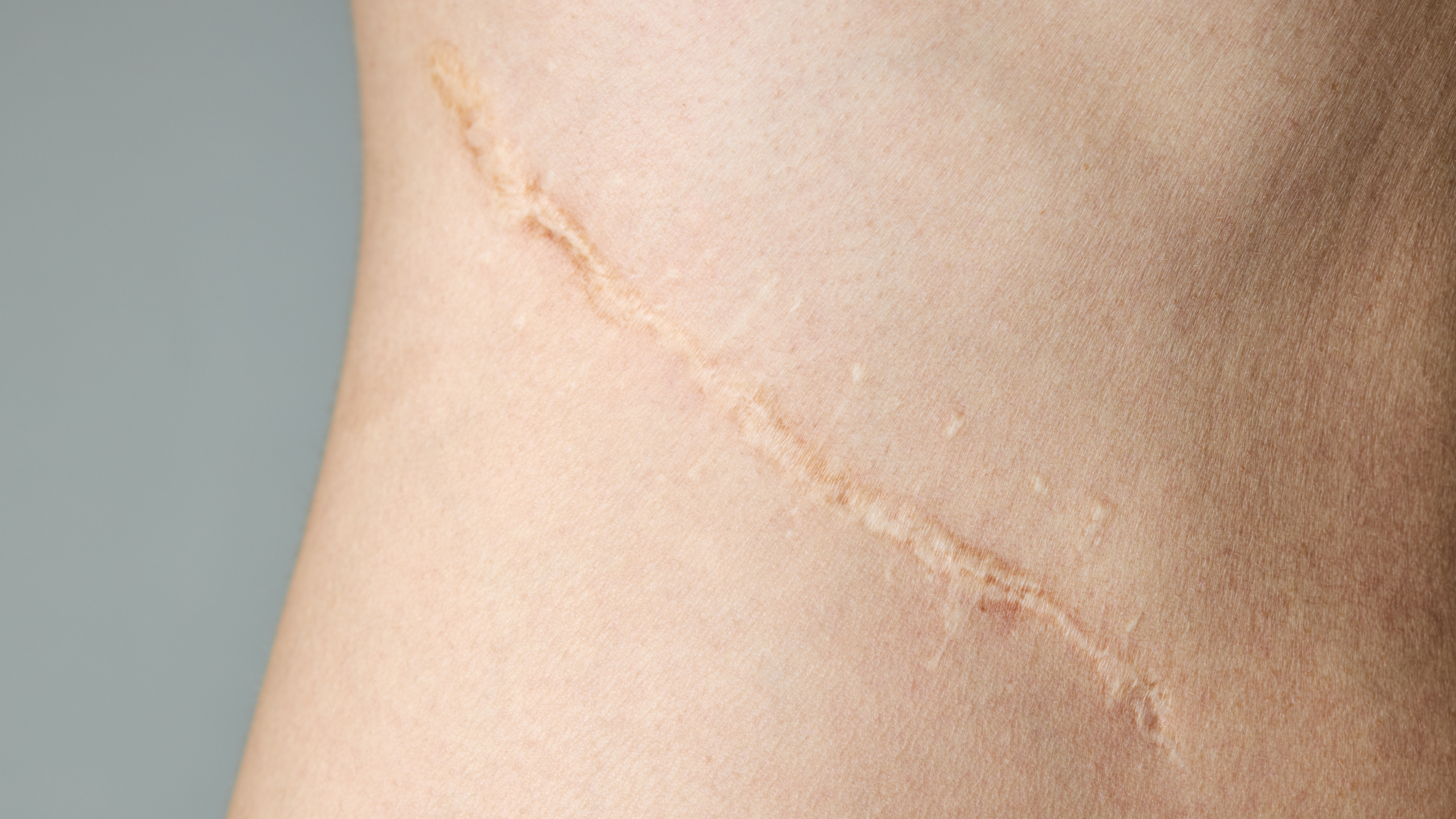 Hyperpigmentation or Hypertrophic? How to Tell What Stage Your Scar Is In (and Treat It Correctly)