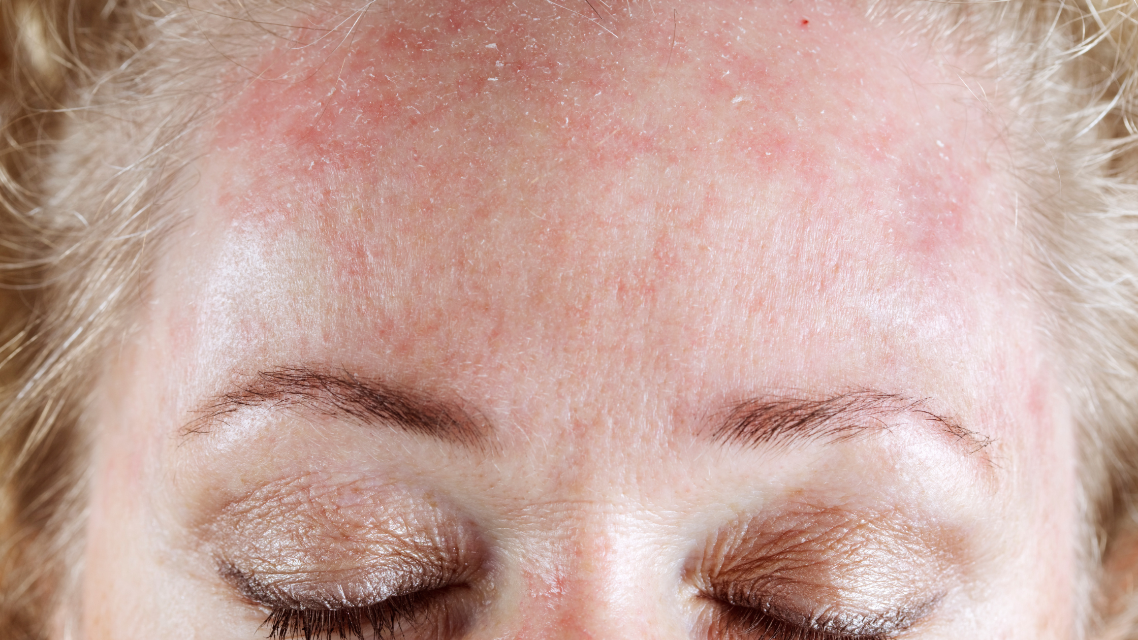 From Treatment to Transformation: How to Safely Rebuild Your Skincare Routine After Radiation