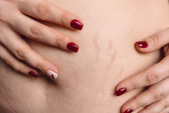 Are Stretch Marks Permanent?