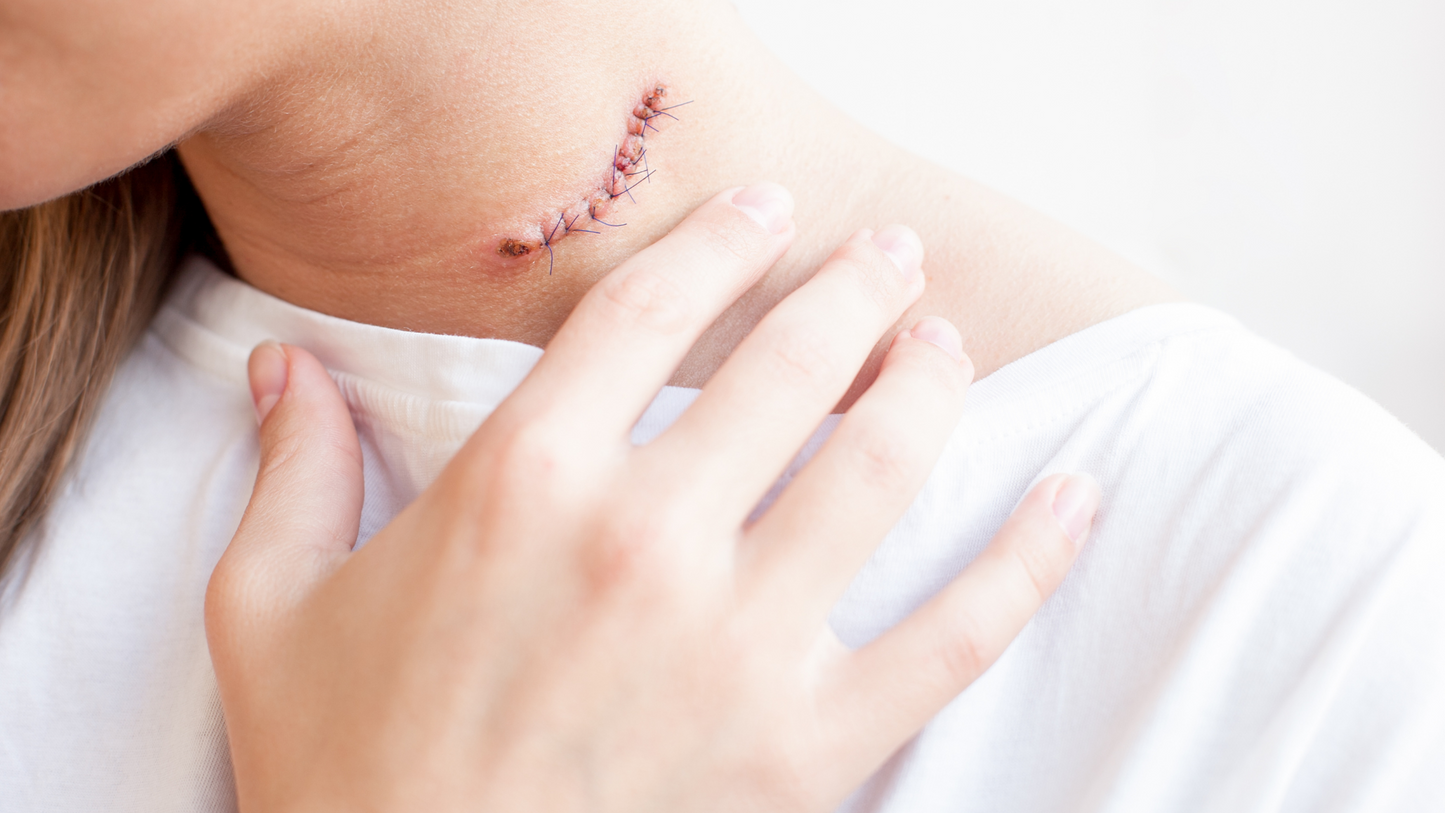 What Is the Best Scar Treatment Route: Surgical or Topical