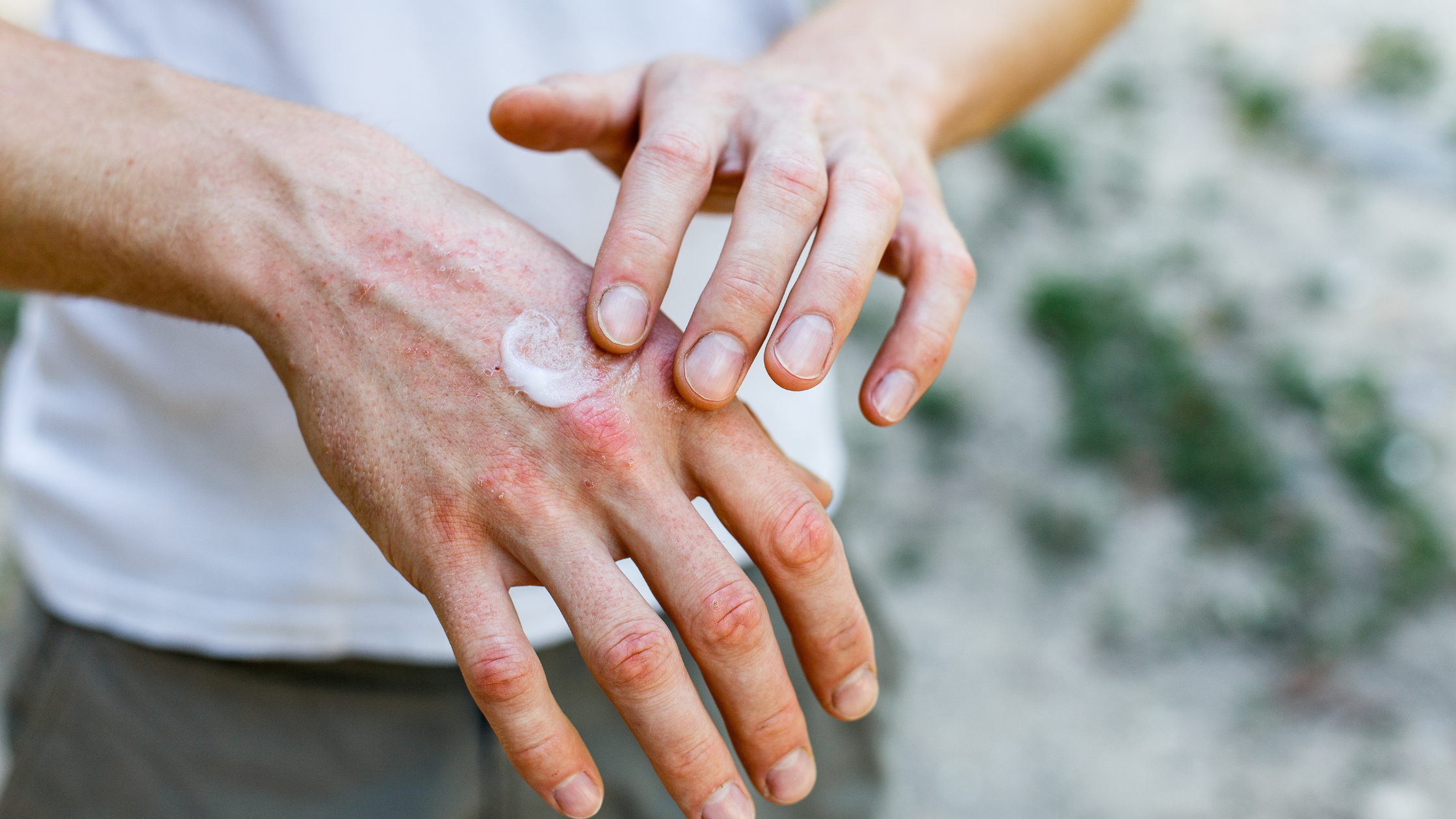 Is Paraffin Bad for Eczema?