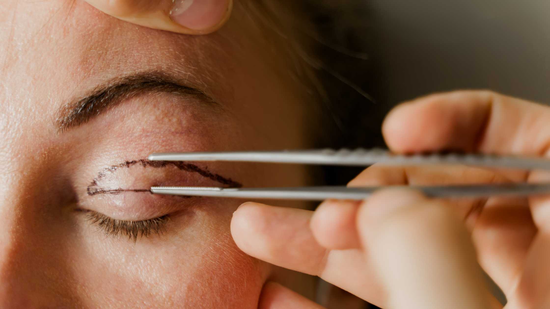 Healing Blepharoplasty Scars: Is Silicone Scar Gel Safe Around The Eyes?