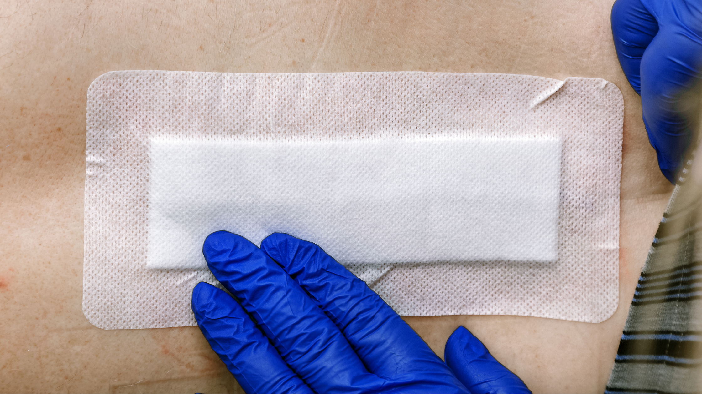 Skin Grafting 101: How Silicone Gel and Sheeting Enhance Healing