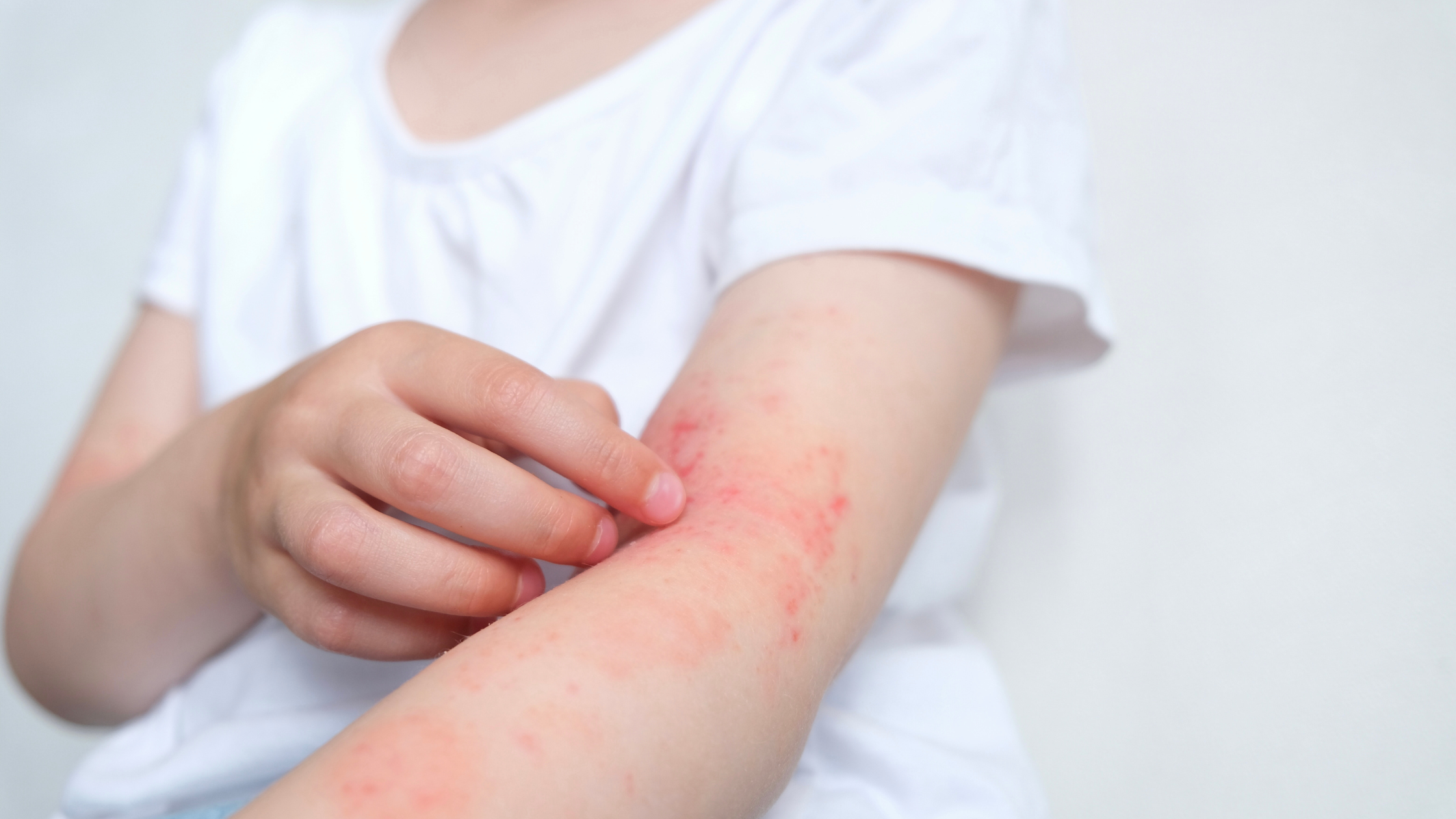 Natural Remedies for Eczema in Infants & Children – The Pros and Cons