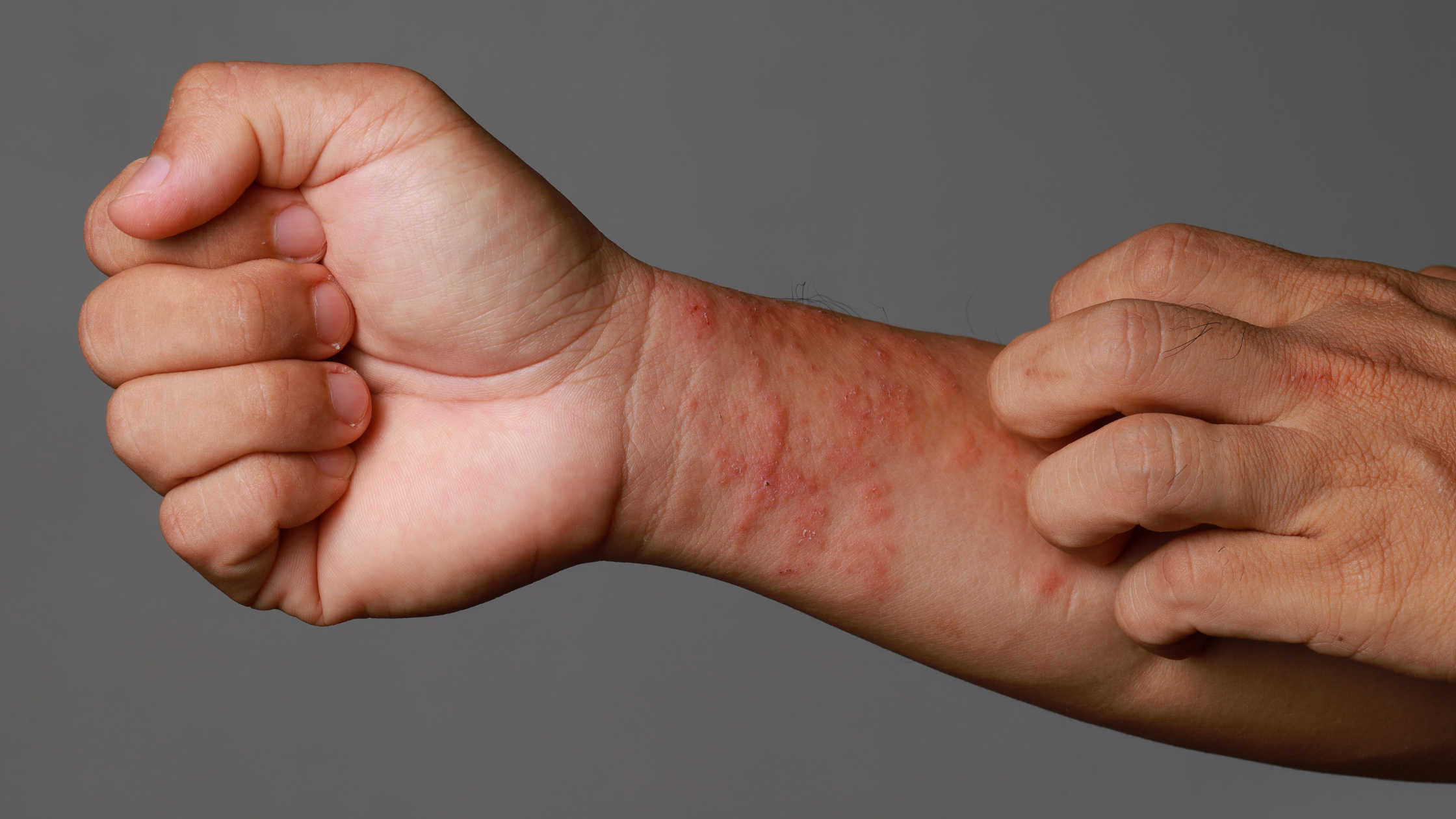 What Does Eczema Look Like? An In-Depth Guide