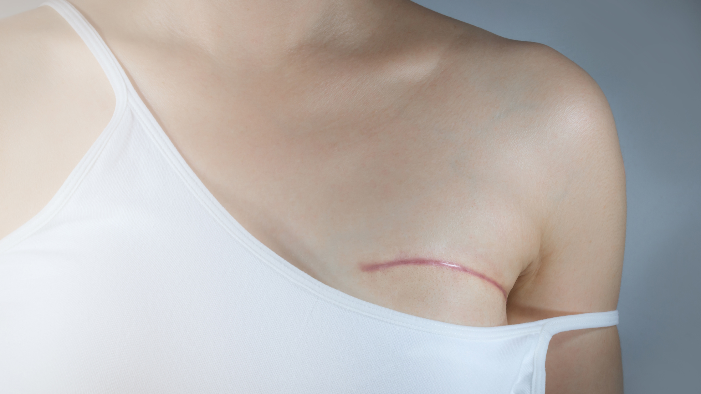 Best Practices After Breast Surgery and Preventing Scars