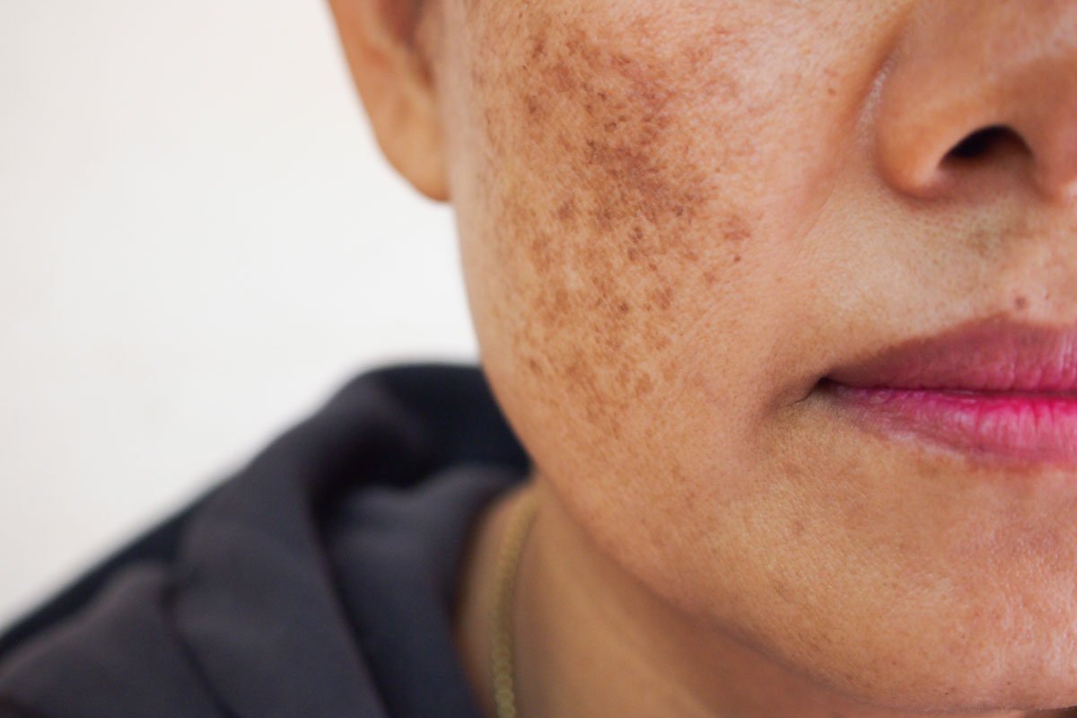 How To Manage Facial Scars