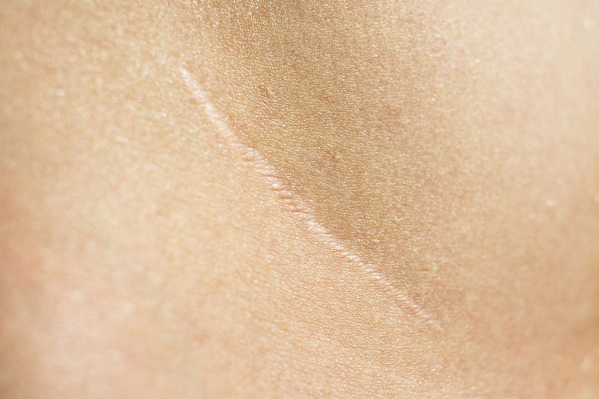 How To Get Rid of Old Scars