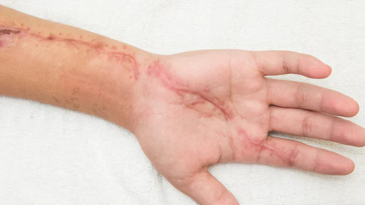 5 Key Ingredients For Scar Management