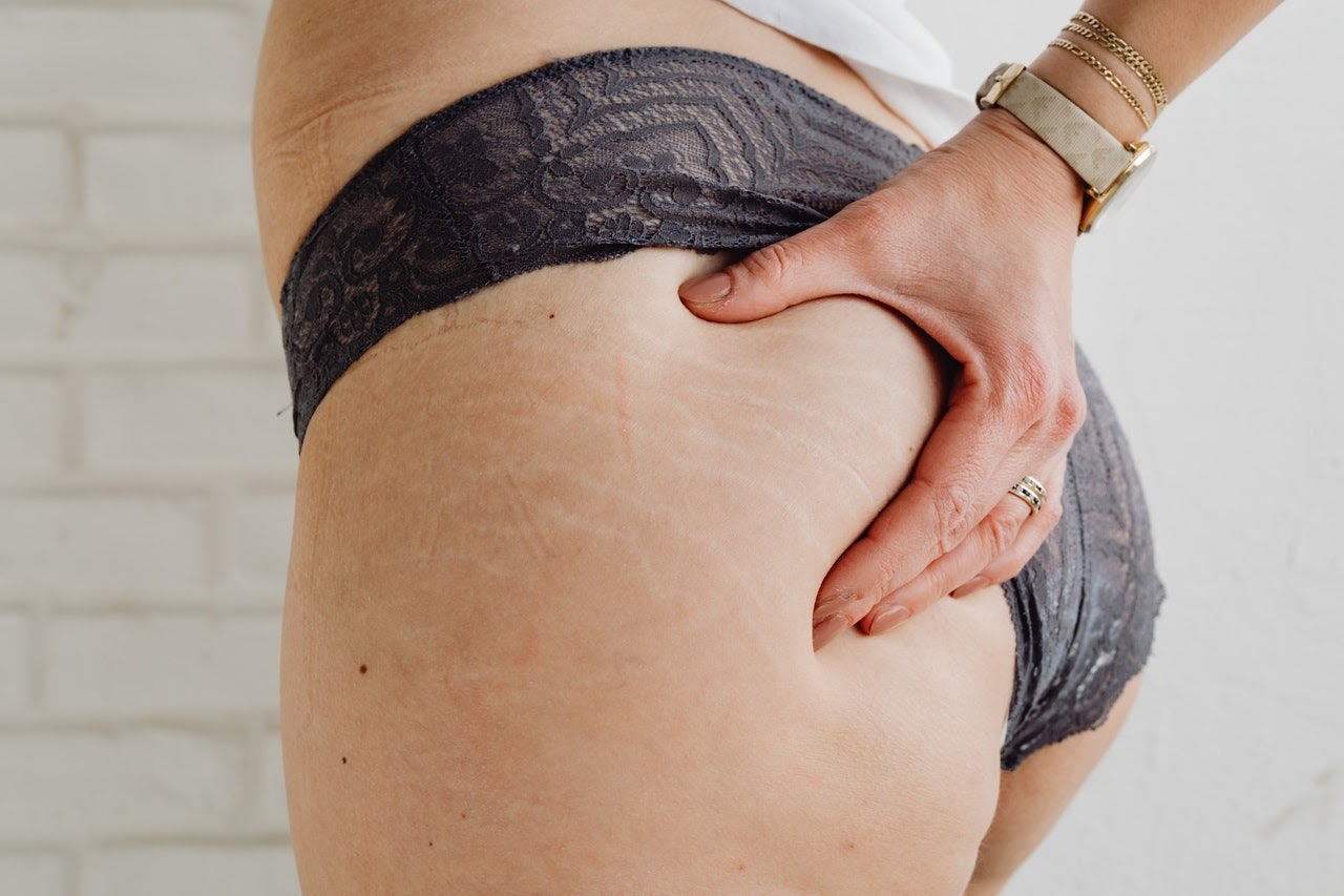 5 Things That Cause Stretch Marks (And How to Get Rid of Them)