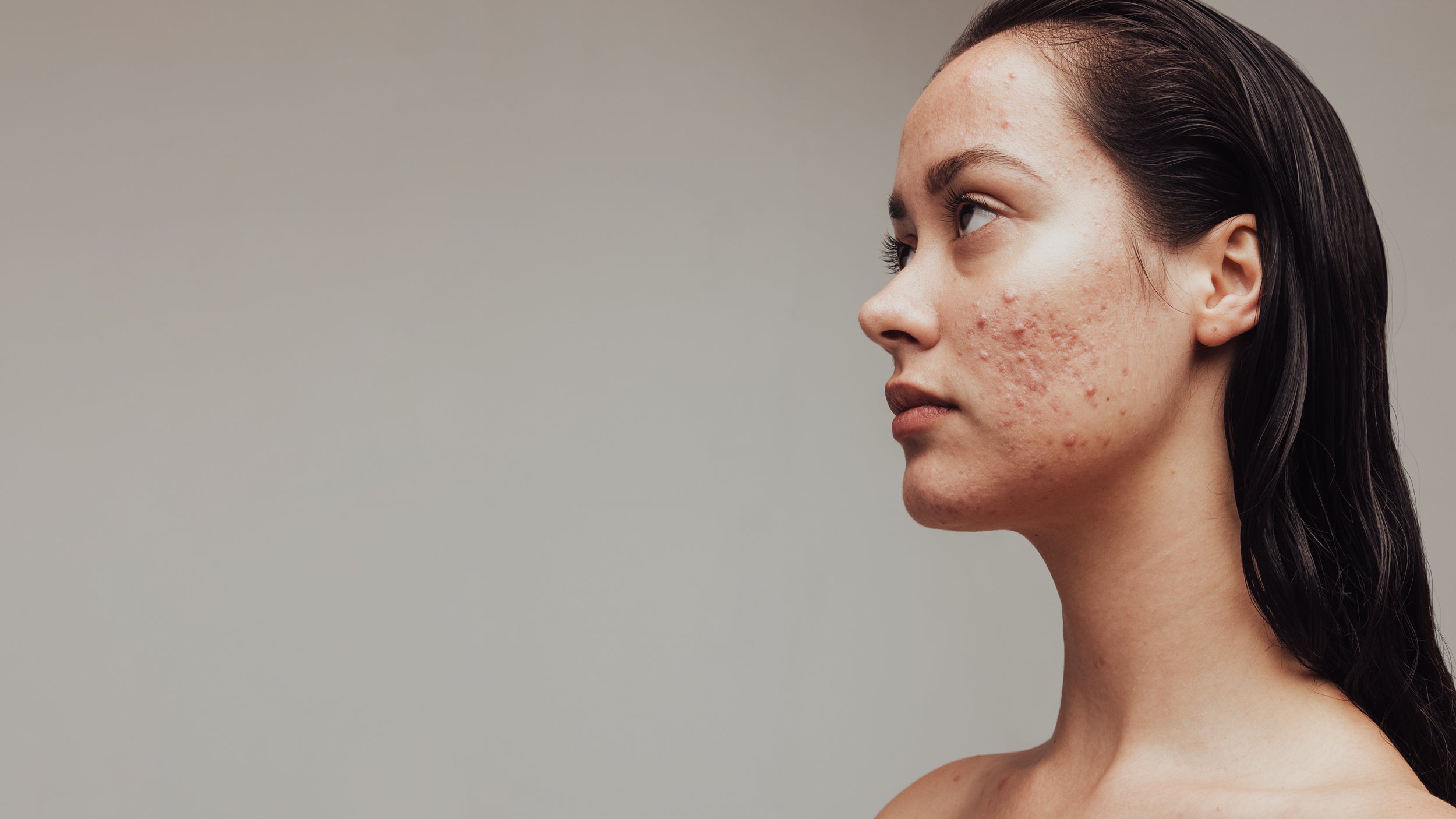 Acne Scarring