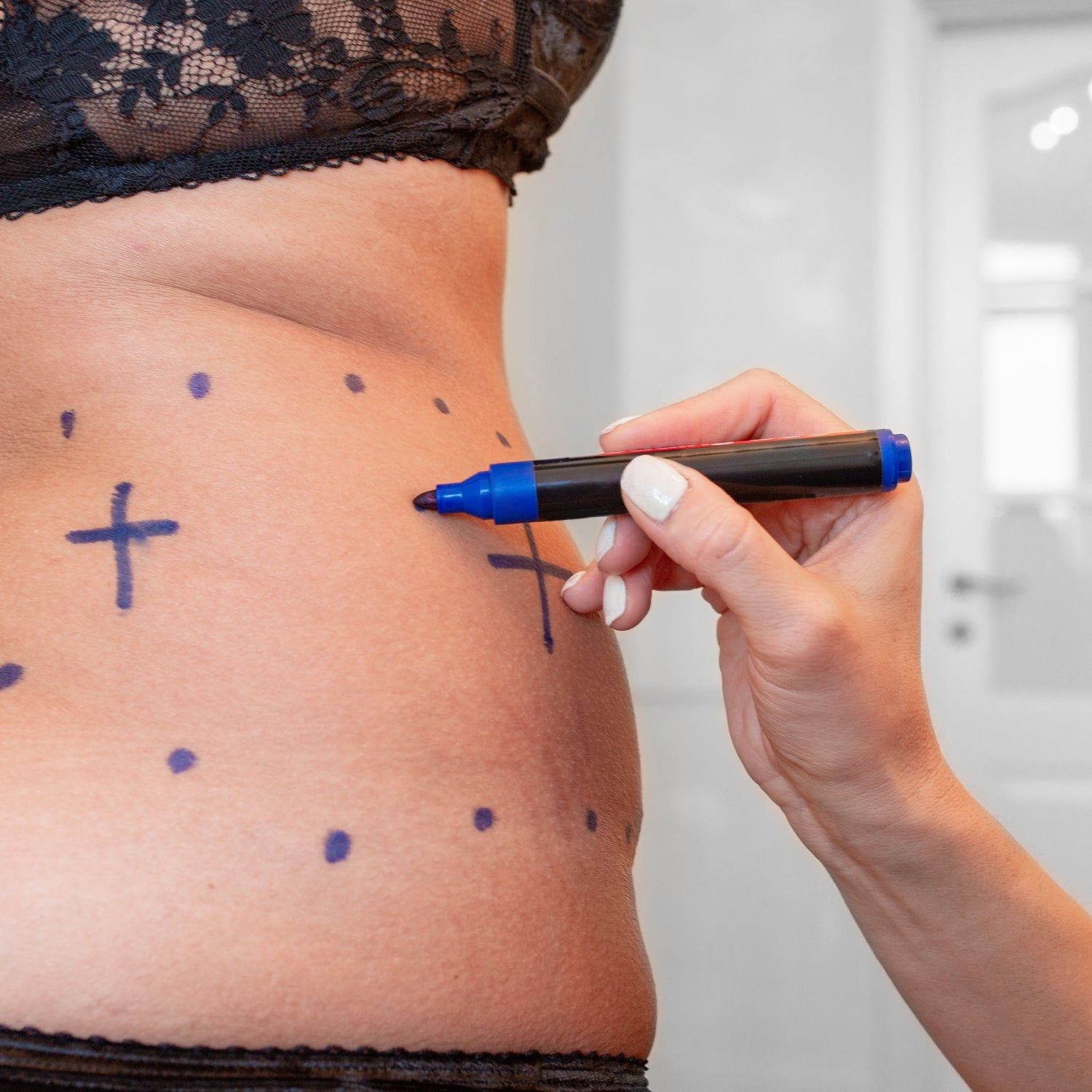 Silicone Scar Management: Post-Op Mommy Makeover Recovery