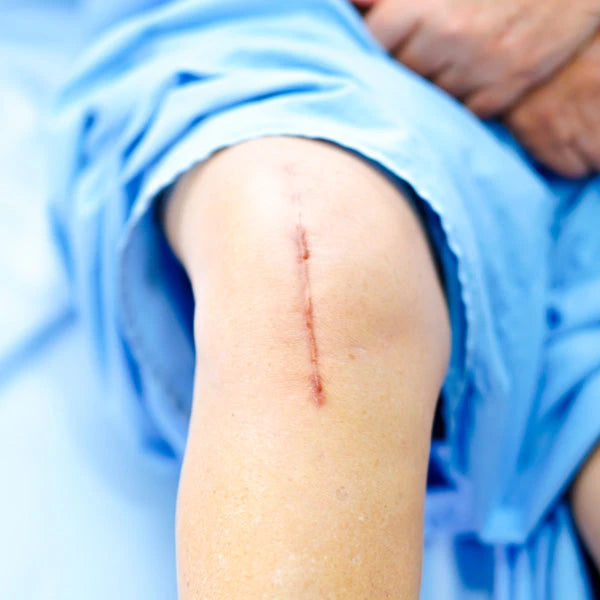 Surgical Scar