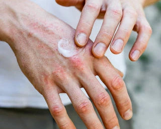 Mild To Moderate Eczema Relief  | Moisturize and Soothe Affected Skin