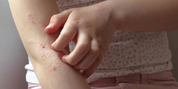 Close-up photo of a girl actively scratching irritated, flaky skin on her arm during an active eczema flare-up, showing characteristics like dry red patches