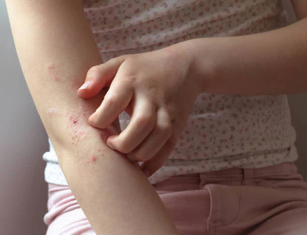 Close-up photo of a girl actively scratching irritated, flaky skin on her arm during an active eczema flare-up, showing characteristics like dry red patches