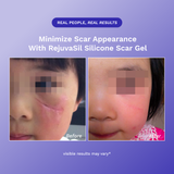 RejûvaSil Silicone Scar Gel