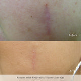 RejûvaSil Silicone Scar Gel