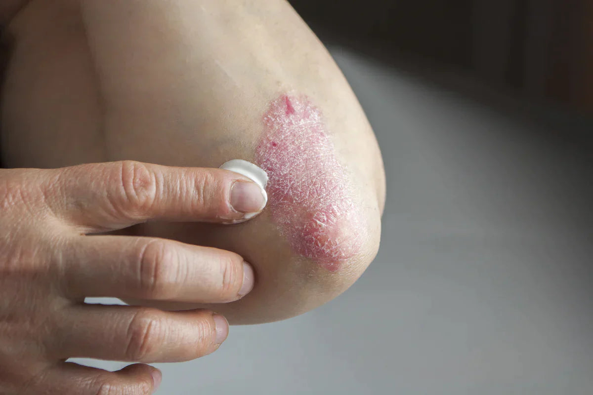 Close-up photo of applying the Skin Recovery Cream to dry, scaly skin during an active eczema flare-up, showing signs of irritation