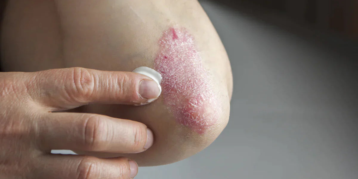 Close-up photo of applying the Skin Recovery Cream to dry, scaly skin during an active eczema flare-up, showing signs of irritation