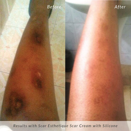 Before & After Burn Care With Scar Esthetique Scar Cream