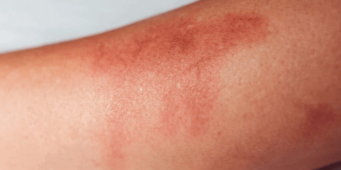 Close-up photo of red, inflamed skin on an arm during an active eczema flare-up, showing characteristic redness and irritation